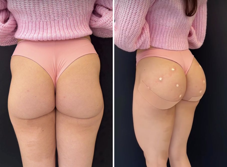 Antes e depois de harmonização glútea