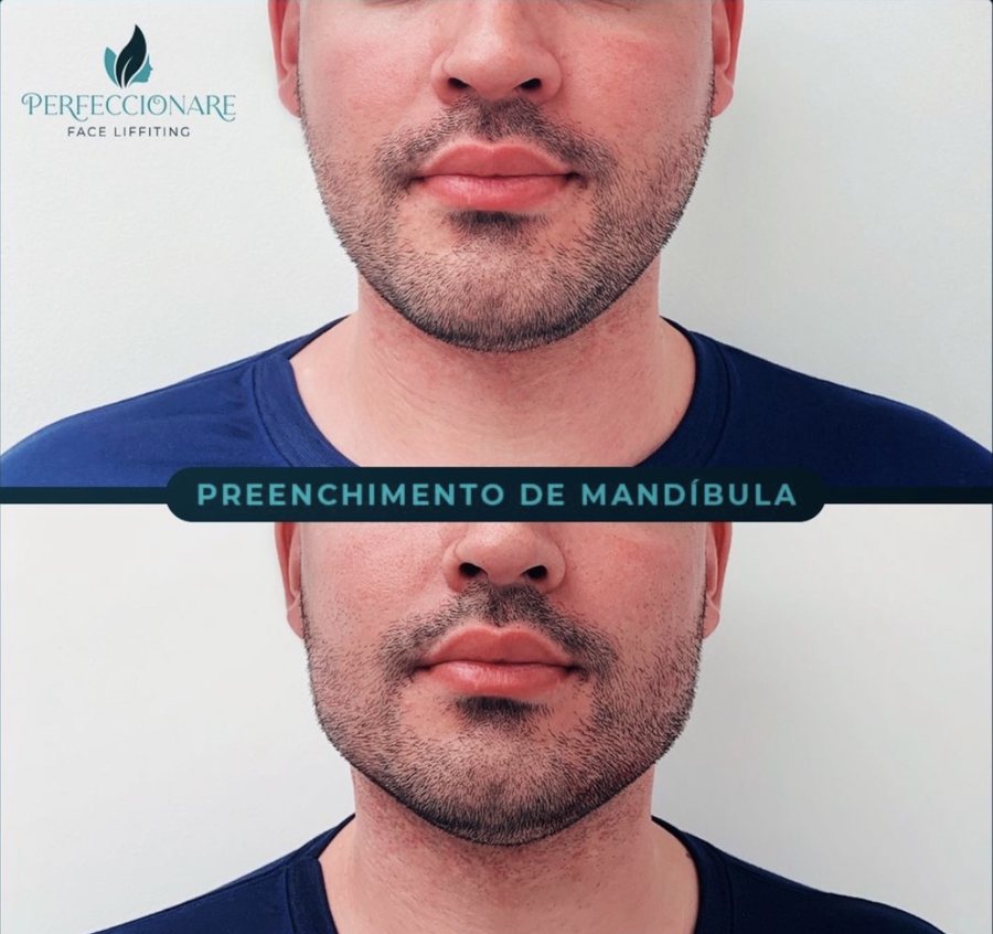 Antes e depois de preenchimento de mandíbula