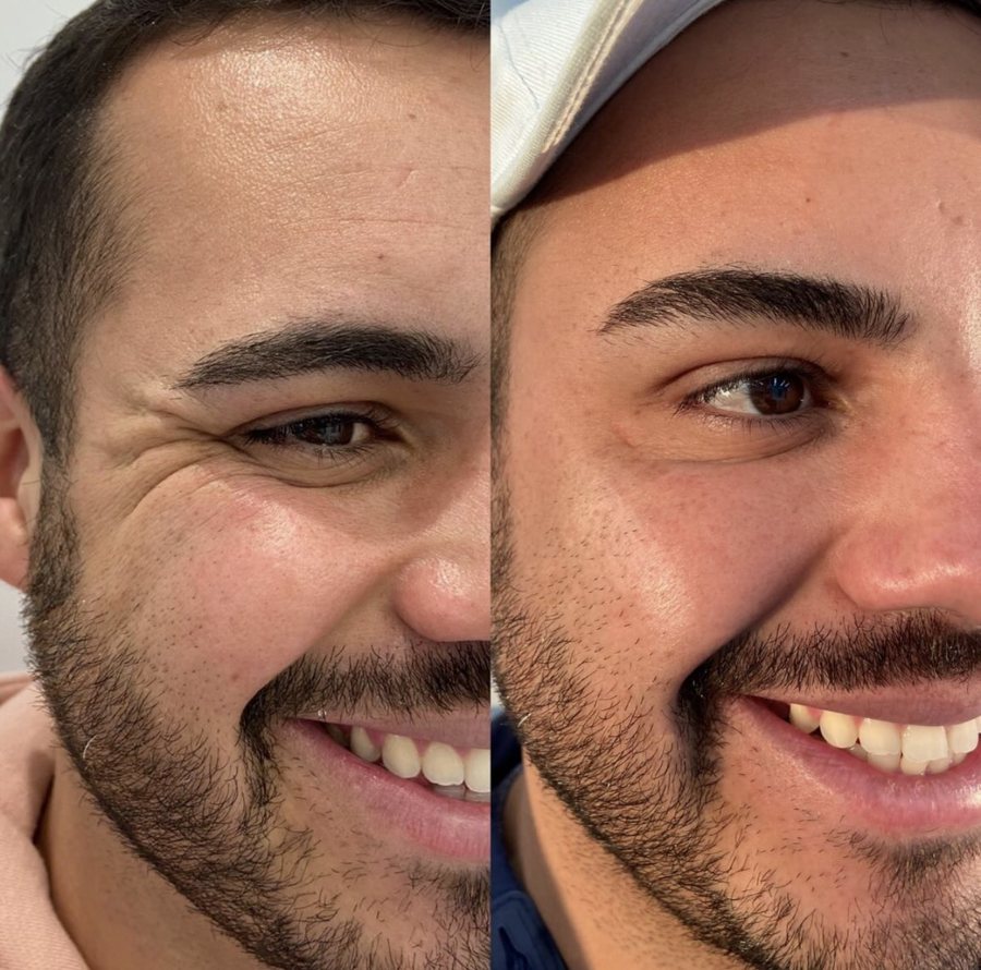 Antes e depois de suavização dos pés de galinha