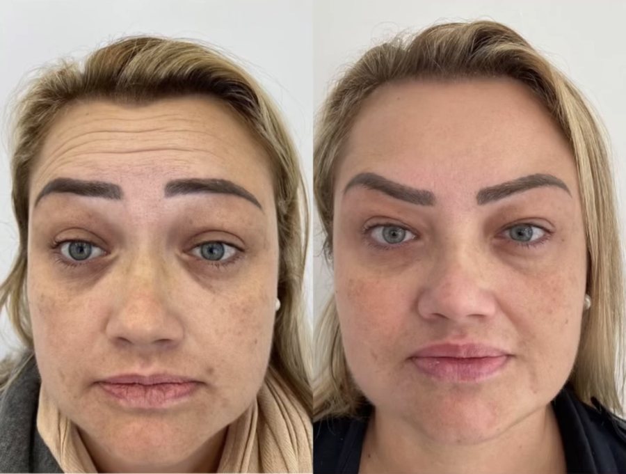 Antes e depois de suavização das linhas da testa